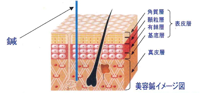 金属の鍼を真皮層まで刺し、赤ちゃん細胞を誘発して成長させ、表皮と角質層の古い細胞を死なせて新しい形質と色彩の表皮を生み出します。